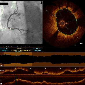 Angio-OCT Co-Registration for Stent Sizing and Optimization