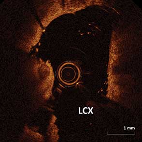 OCT Guidance in Bifurcation PCI of Proximal LCx and LAD
