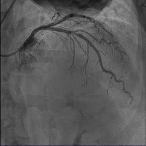 Angiographic Haziness Caused by Heavy Calcification