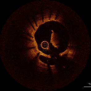 Very Late Thrombus NSTEMI Due to Malapposition