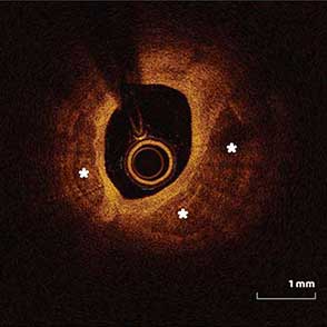 Orbital Atherectomy of Severely Calcified LAD Lesion