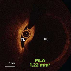 Recurrent Spontaneous Coronary Artery Dissection