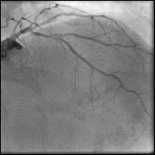 Case 13: Calcified Prox LAD and Angulated Diagonal Bifurcation Intervention