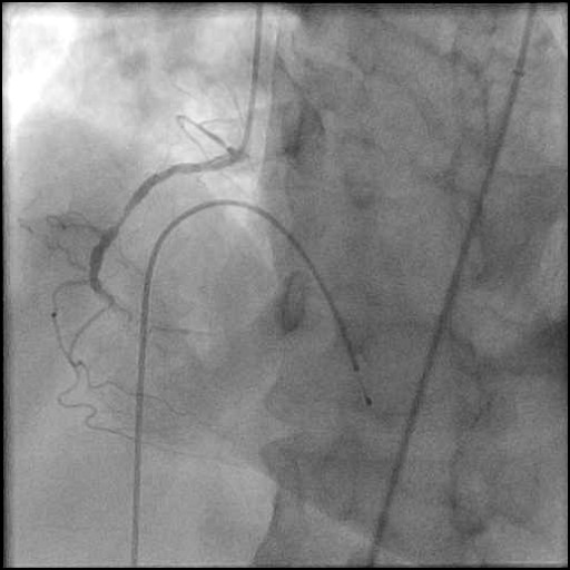 Case 15: Rotational Atherectomy and DES of CTO RCA BMS ISR