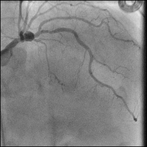 Case 19: Revascularization of Calcific LM Bifurcation and Aneurysmal pLAD