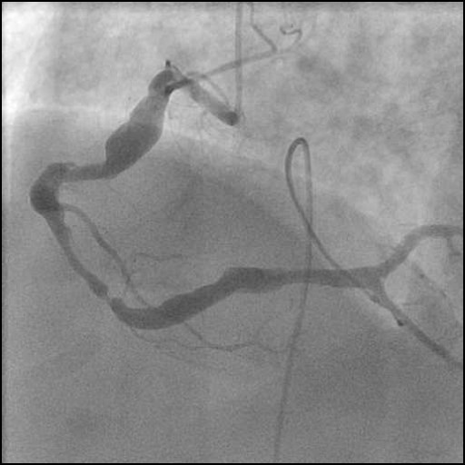 Case 2: Ectatic And Severely Tortuous Long ISR of RCA