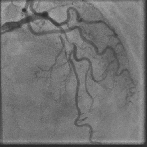 Case 22: Extremely Tortuous Angulated mid LAD Diagonal Bifurcation Lesion