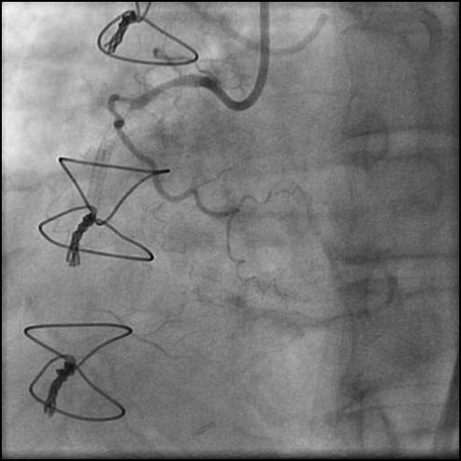 Case 5: Complex Proximal RCA CTO ISR Via Antegrade Approach Followed By Laser Atherectomy And Atherotomy