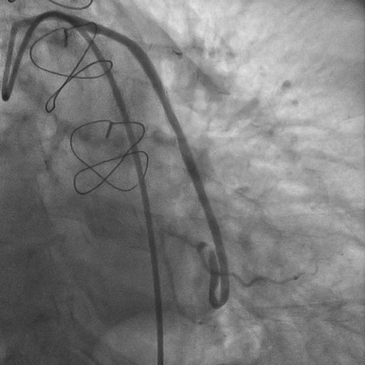 Case 7: Severely Angulated Vein Graft PCI