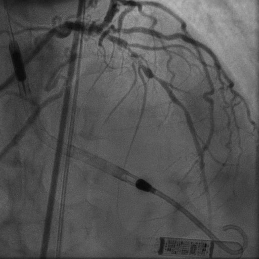 Case 9: Protected PCI of complex calcified LAD using OA and DES with Impella LV assist