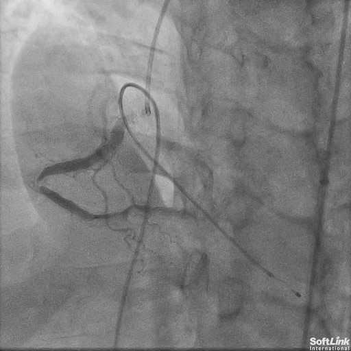 Case 24: Complex PCI of Tortuous Calcified RCA Using Rota With Guide Extension Support
