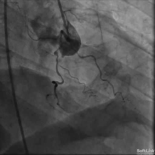 Case 26: Severely Angulated and Tortuous RCA Intervention