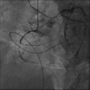 OCT Guided PCI of DES-ISR CTO