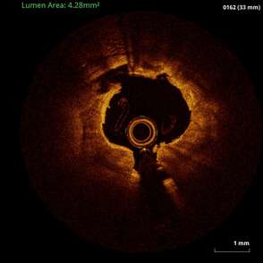 Intravascular Lithotripsy for Severely Calcified Coronary Lesions